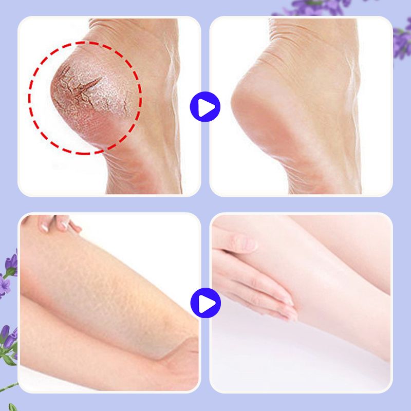 🔥Nourishing and repairing dry and cracked skin  Look 20 years❤️ younger in an instant  Limited time 77% off  Come and give your feet a fresh new look!